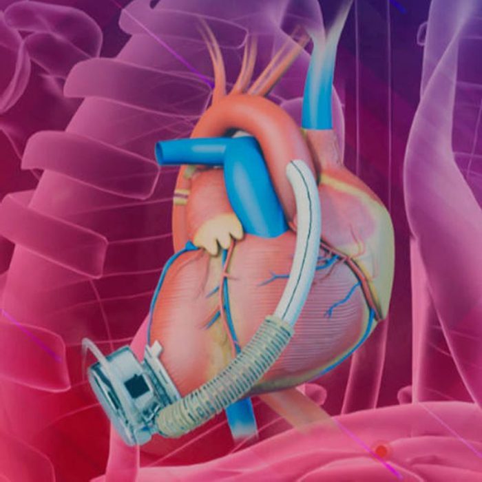 Adult Ventricular Assist Device
