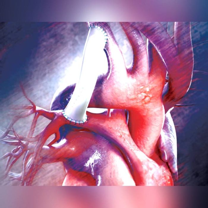 Aorta Vascular Prosthesis 1
