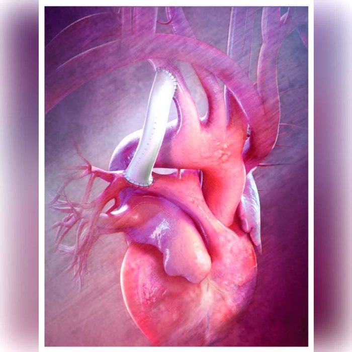 Aorta Vascular Prosthesis 2