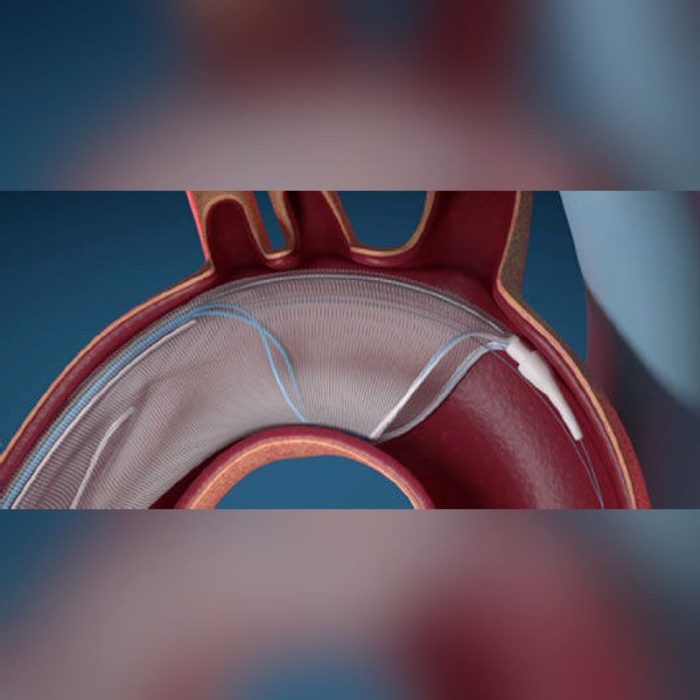 Emboline Protection Device Durable Aortic Embolic Protection System Sale or Rent Near Me ...
