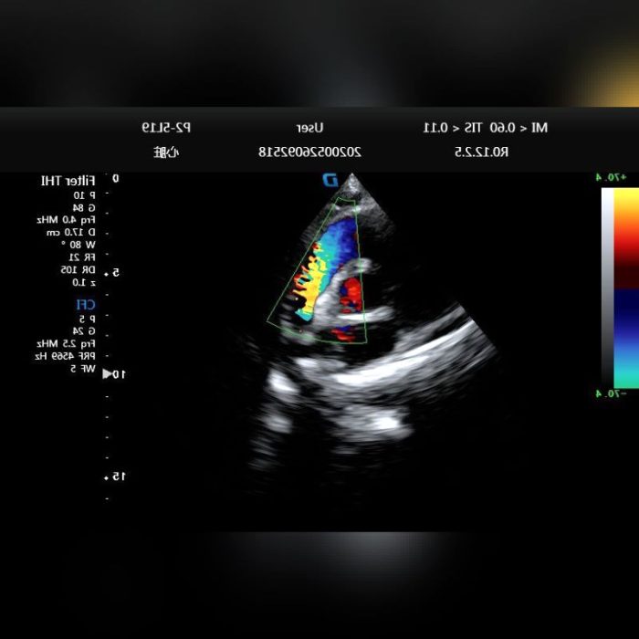 Cardiovascular Ultrasound Imaging System 8
