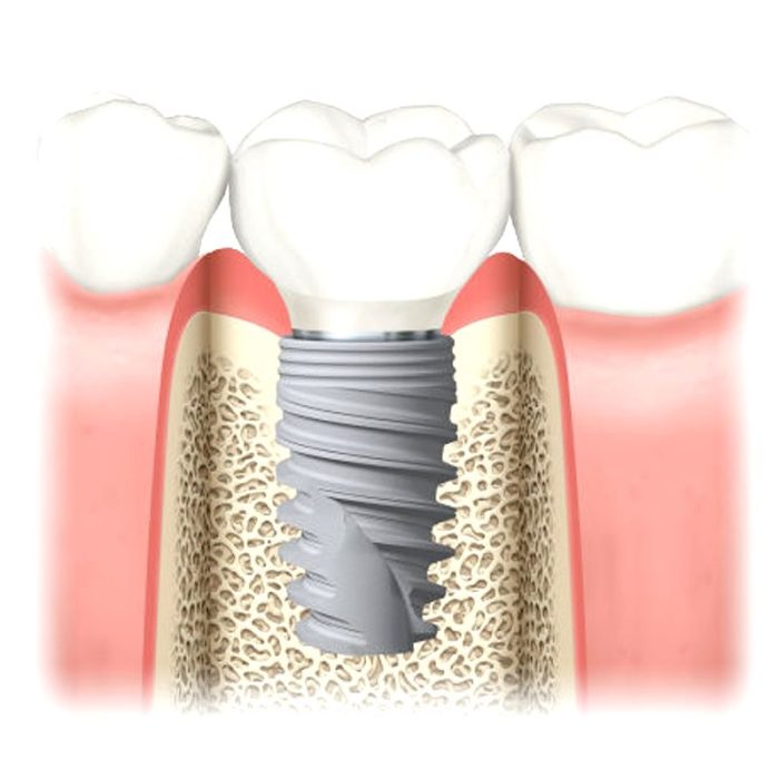 Conical Dental Implant 2