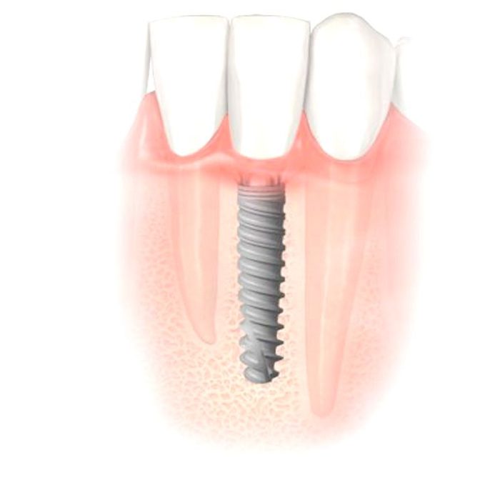 Conical Dental Implant 4