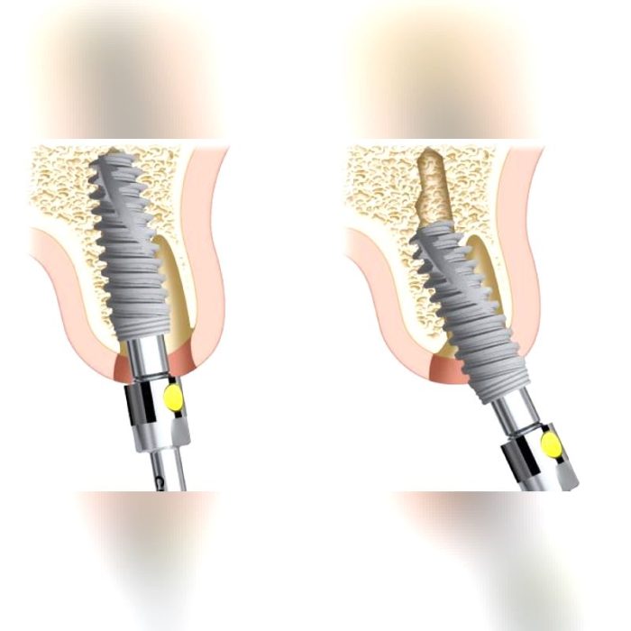 Conical Dental Implant 5
