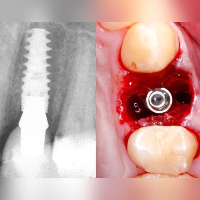 Conical Dental Implant 6
