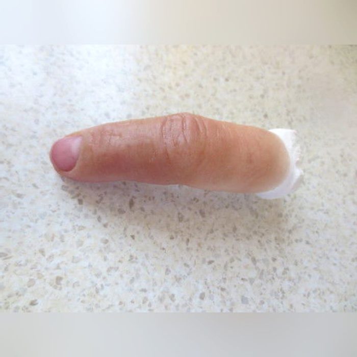 Finger Cosmetic Prosthesis 5