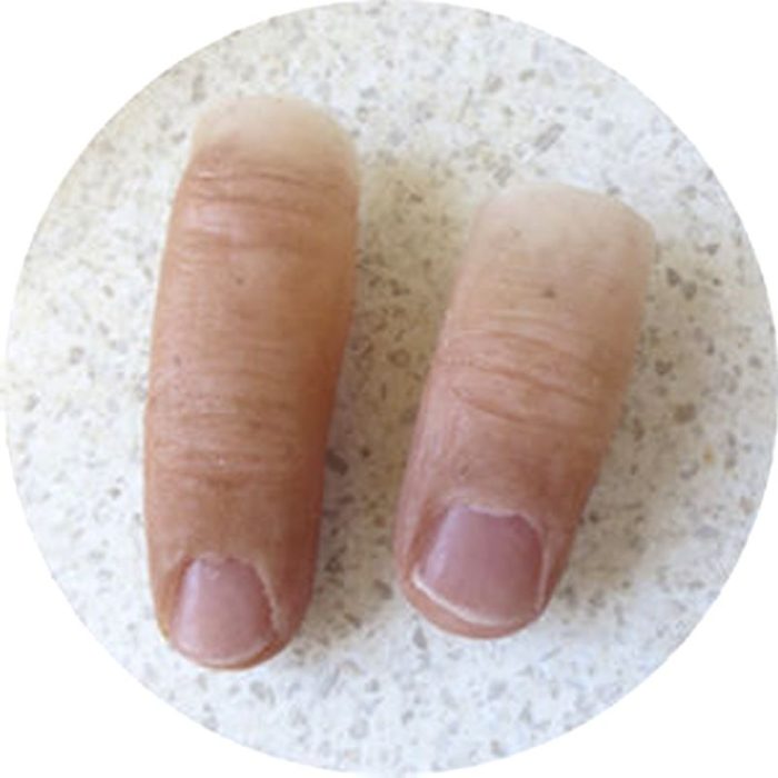 Finger Cosmetic Prosthesis