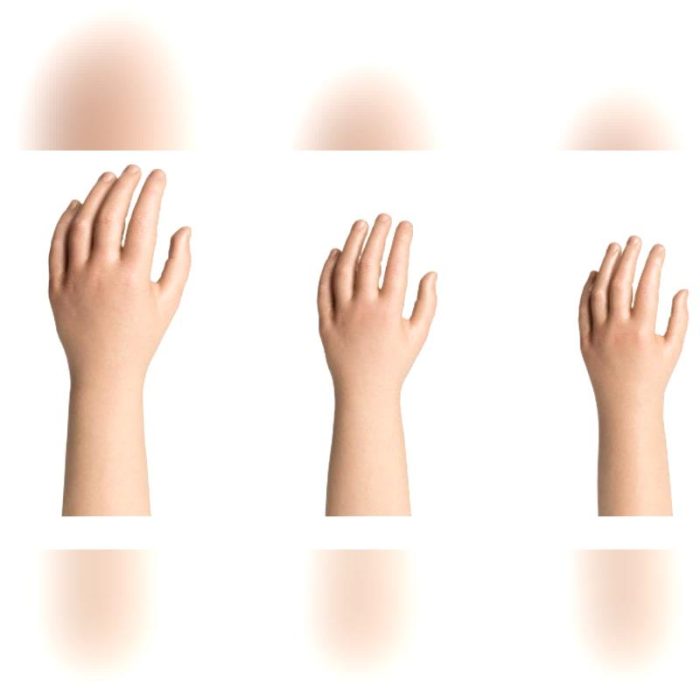 Hand Cosmetic Prosthesis 1