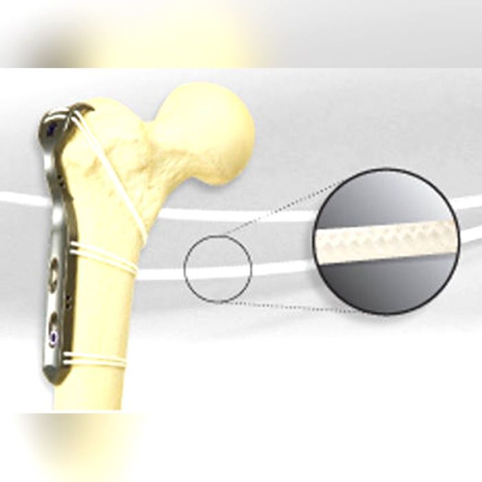Hip Revision Surgery Bone Cerclage Wiring 1
