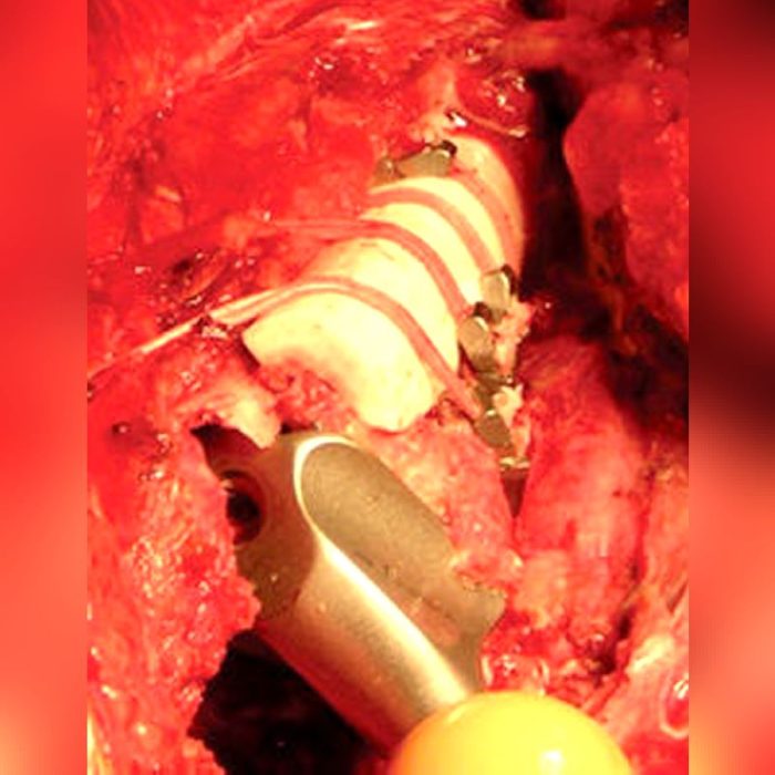 Hip Revision Surgery Bone Cerclage Wiring 4