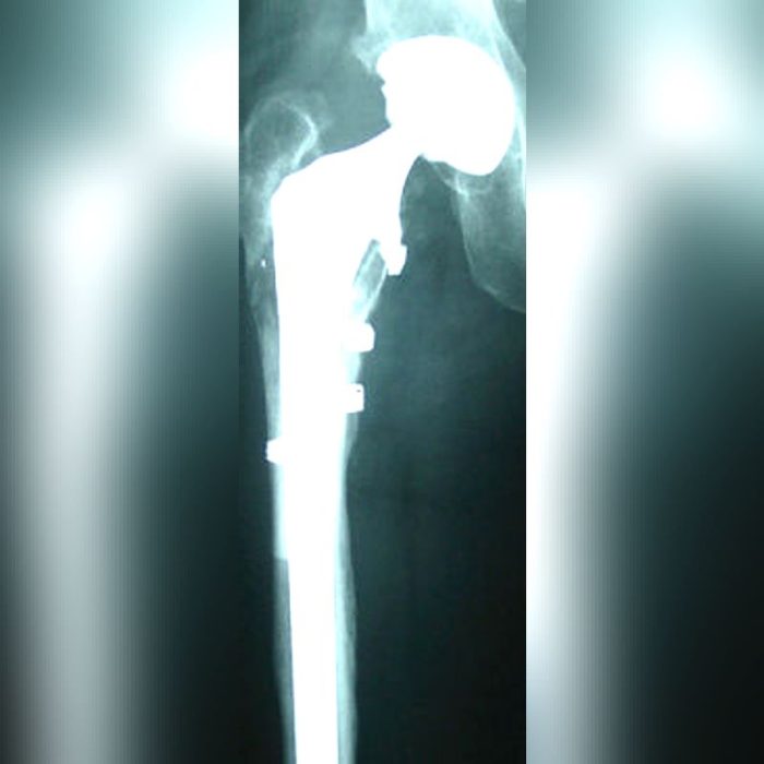 Hip Revision Surgery Bone Cerclage Wiring 5