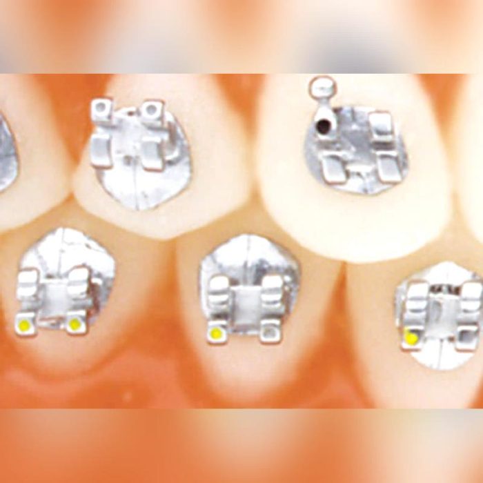 Metal Orthodontic Bracket 2