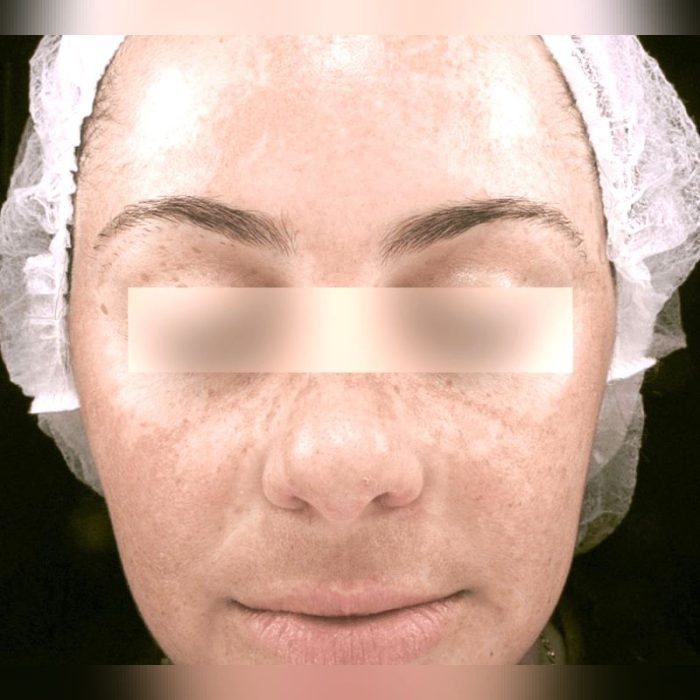 Skin Rejuvenation Laser 2