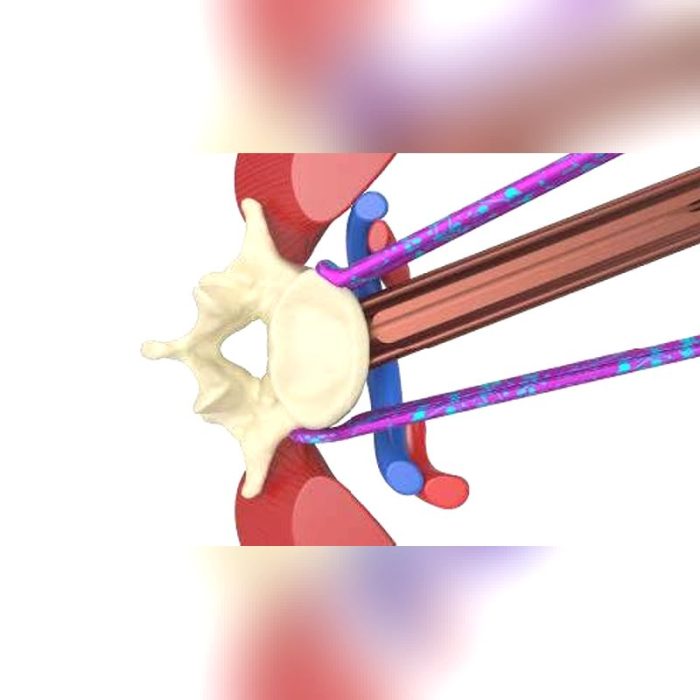Spinal Retractor 1