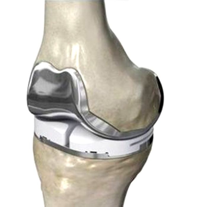 Three-Compartment Knee Prosthesis 2