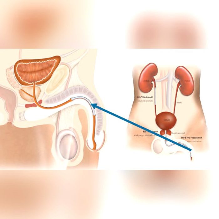 Urethral Stent 2