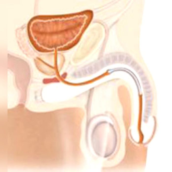 Urethral Stent