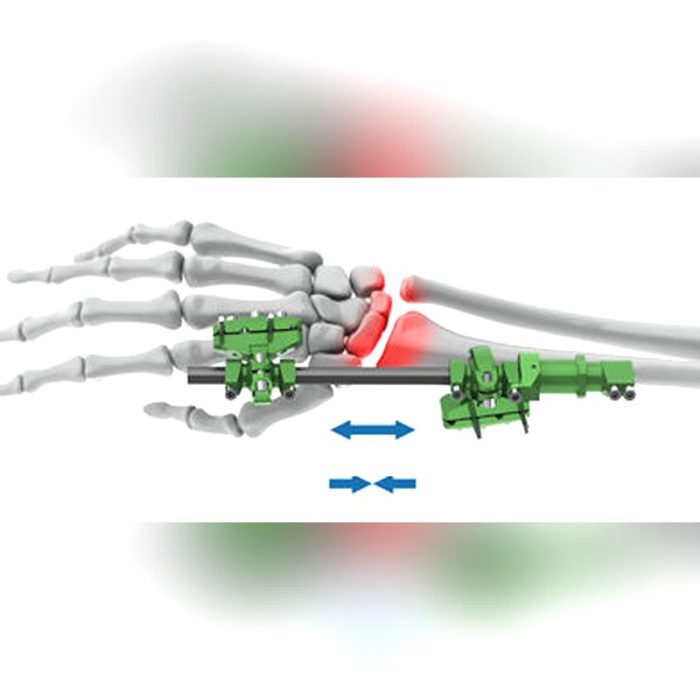 Wrist External Fixation System 5